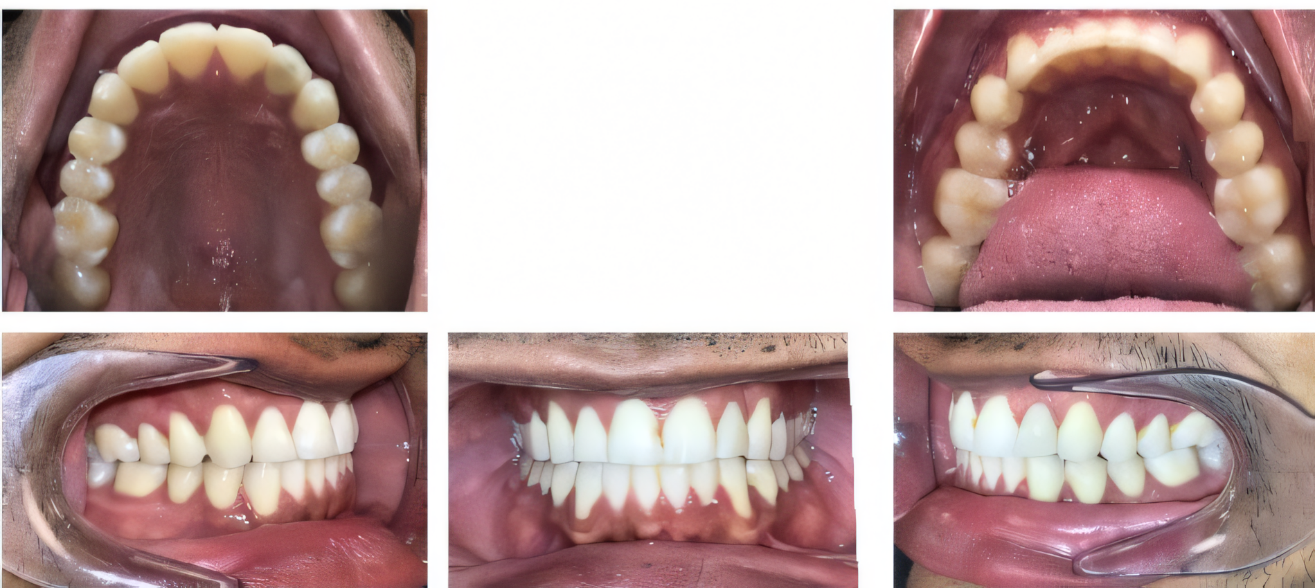 Invisalign touch up after